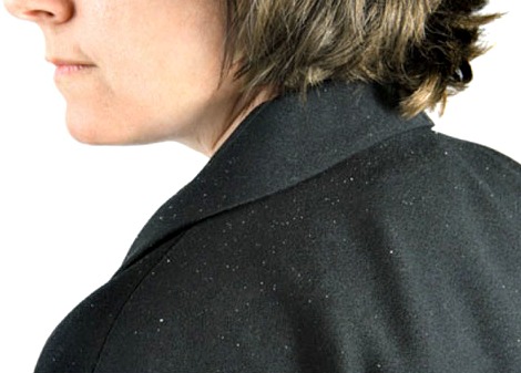 dandruff-shoulders-flickr